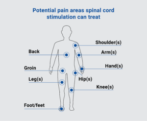 spinal cord stimulator